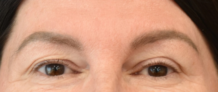Brow Lift Patient 1 Set 1 Before
