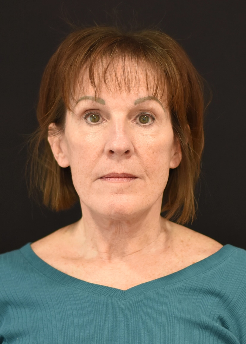 Extended Deep Plane Facelift Patient 2 Set 1 After