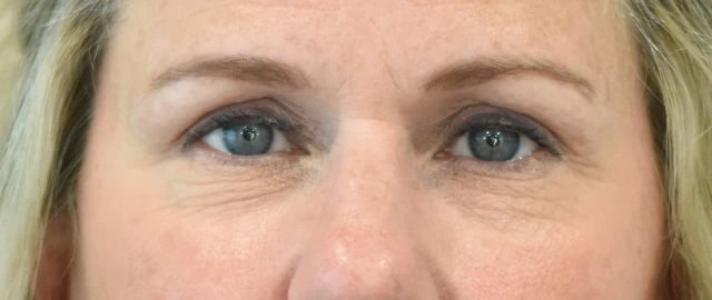 Brow Lift Patient 11 Set 1 After