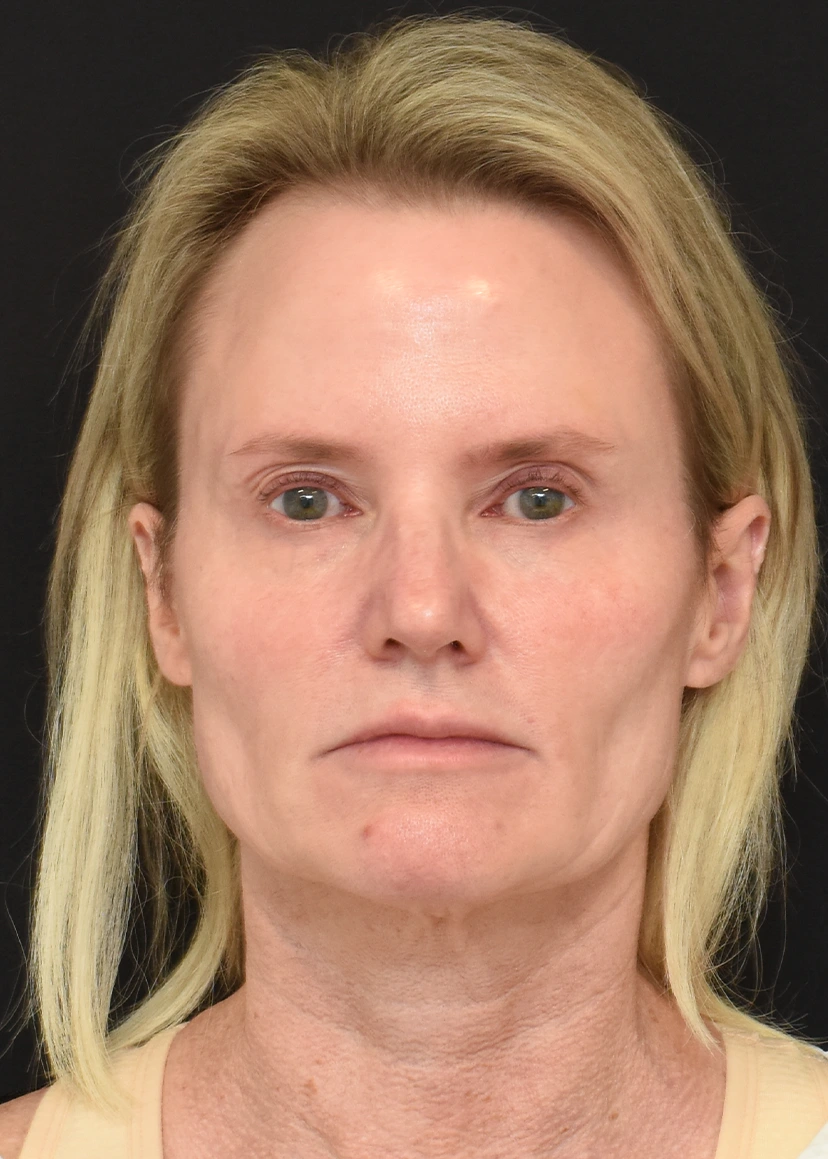 Deep Plane Facelift Patient 35 Set 1 Before