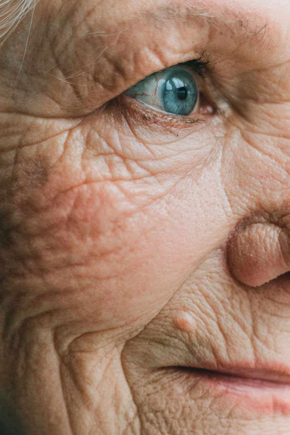 Skin Care After Laser Resurfacing of the Face