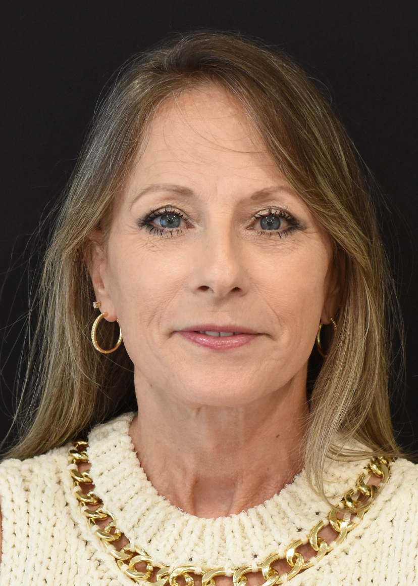 Deep Plane Facelift Patient 24 Set 1 After