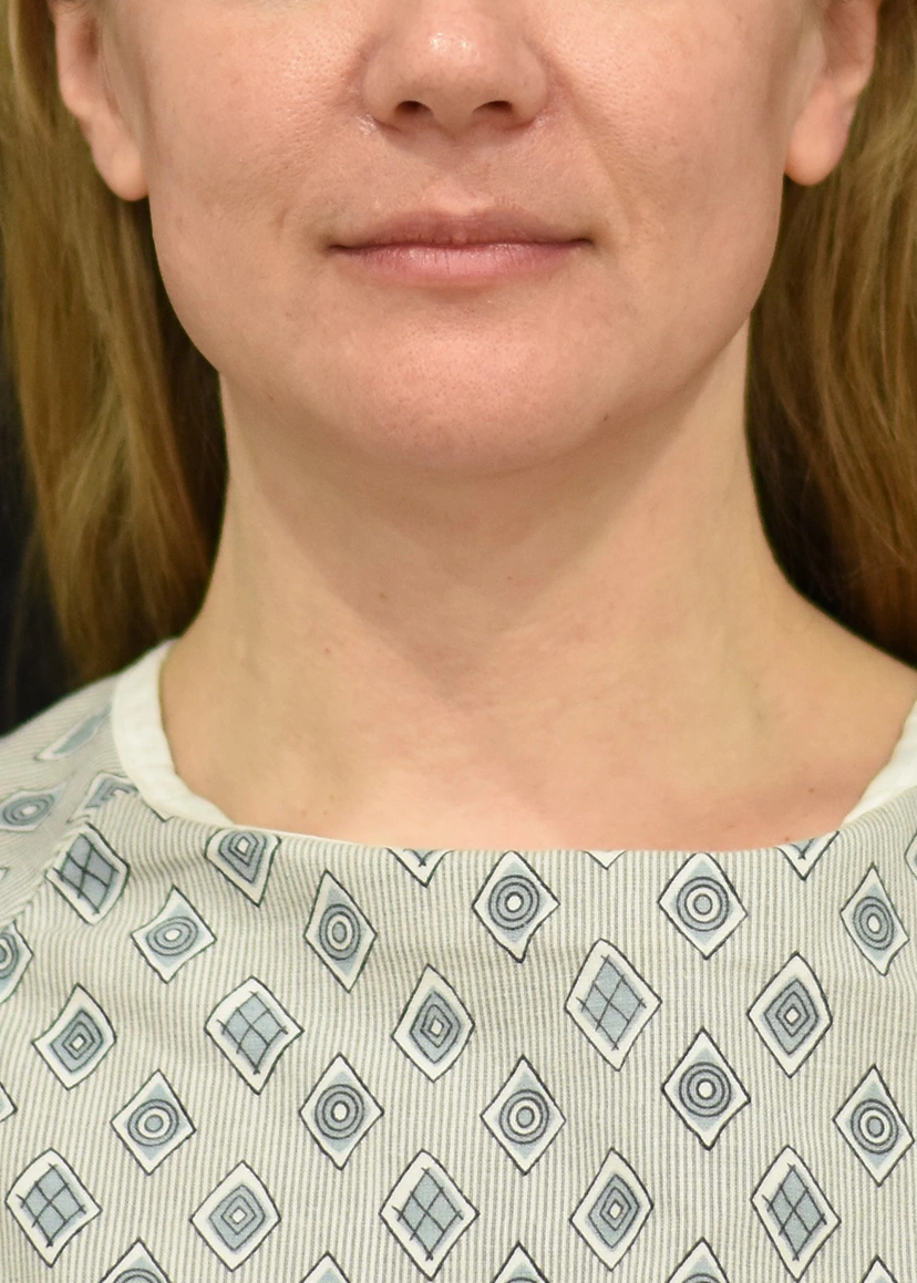 Deep Plane Facelift Patient 23 Set 1 Before