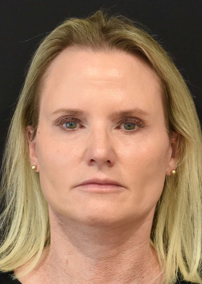 Deep Plane Facelift Patient 35 Set 1 After