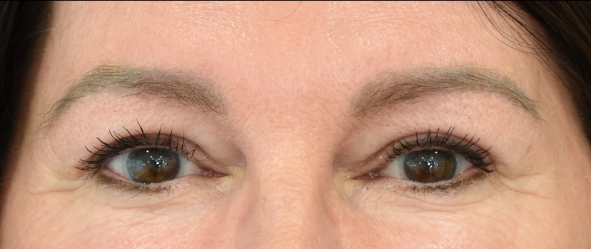 Brow Lift Patient 1 Set 1 After