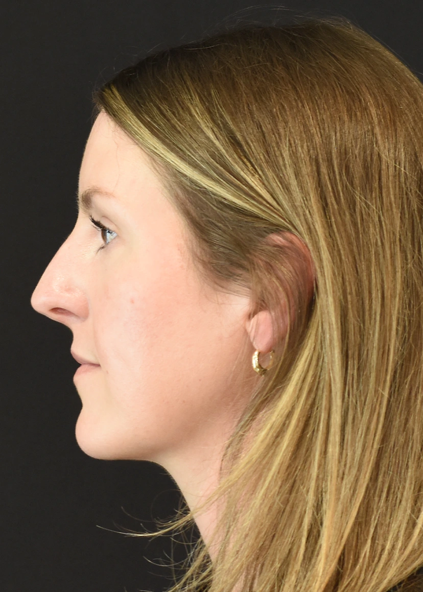 Rhinoplasty Patient 9 Set 3 Before