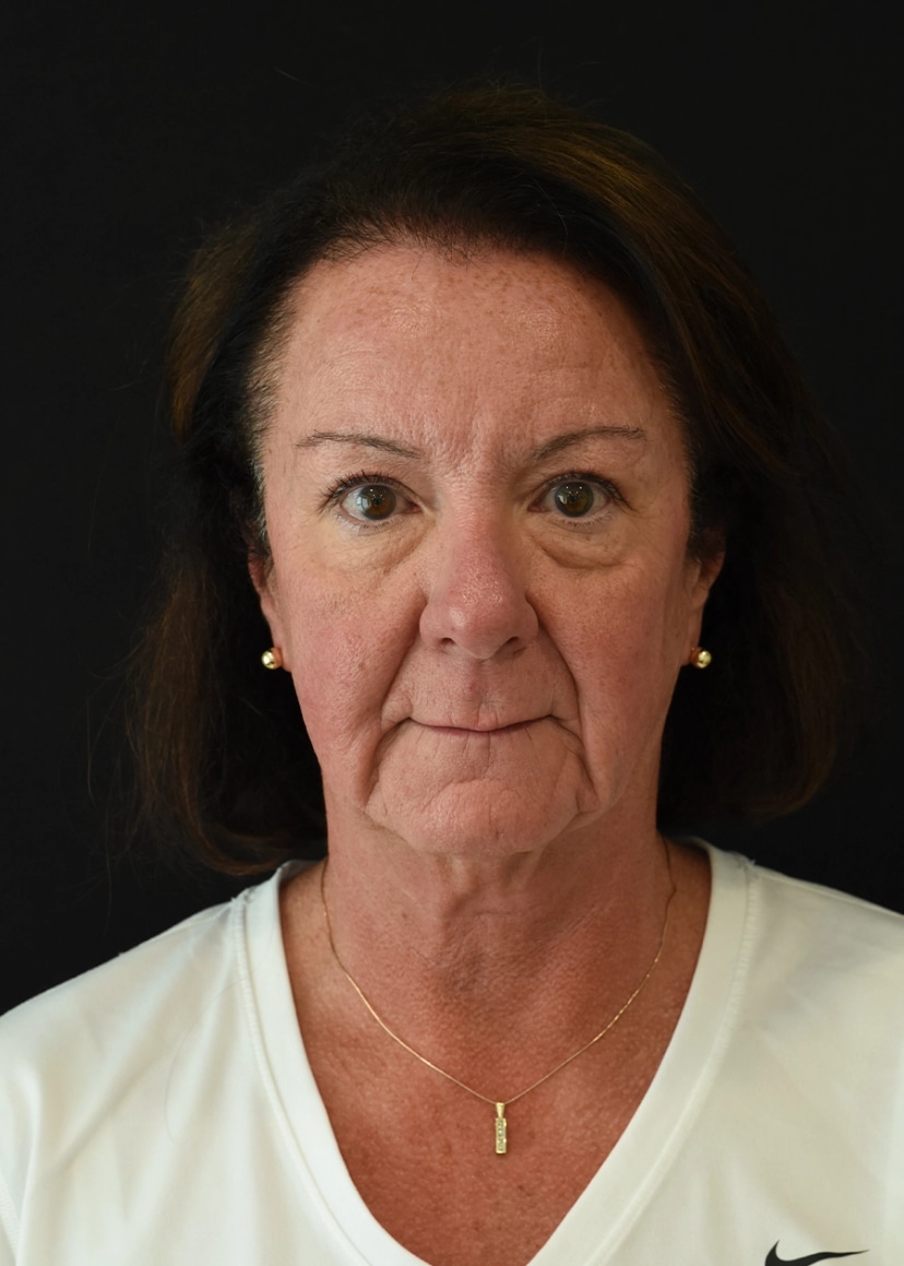 Extended Deep Plane Facelift Patient 5 Set 1 Before