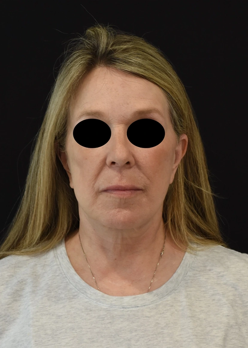 Deep Plane Facelift Patient 15 Set 1 After