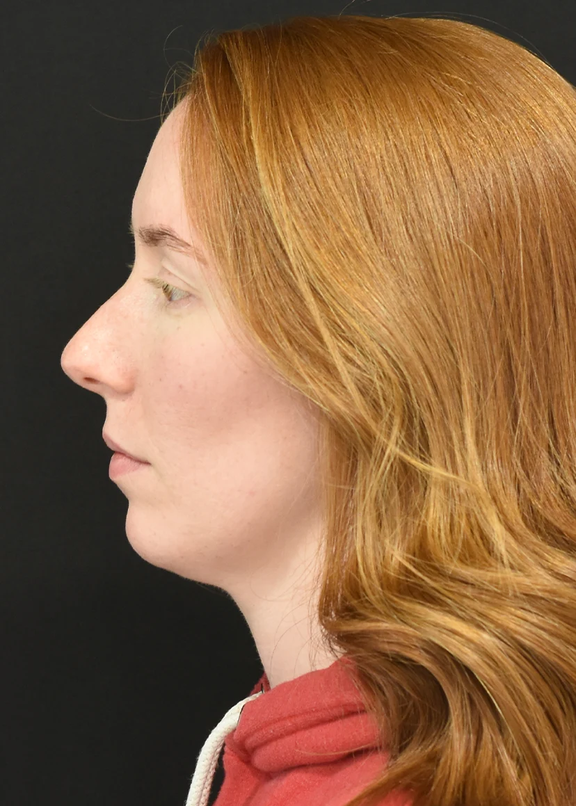 Rhinoplasty Patient 8 Set3 Before