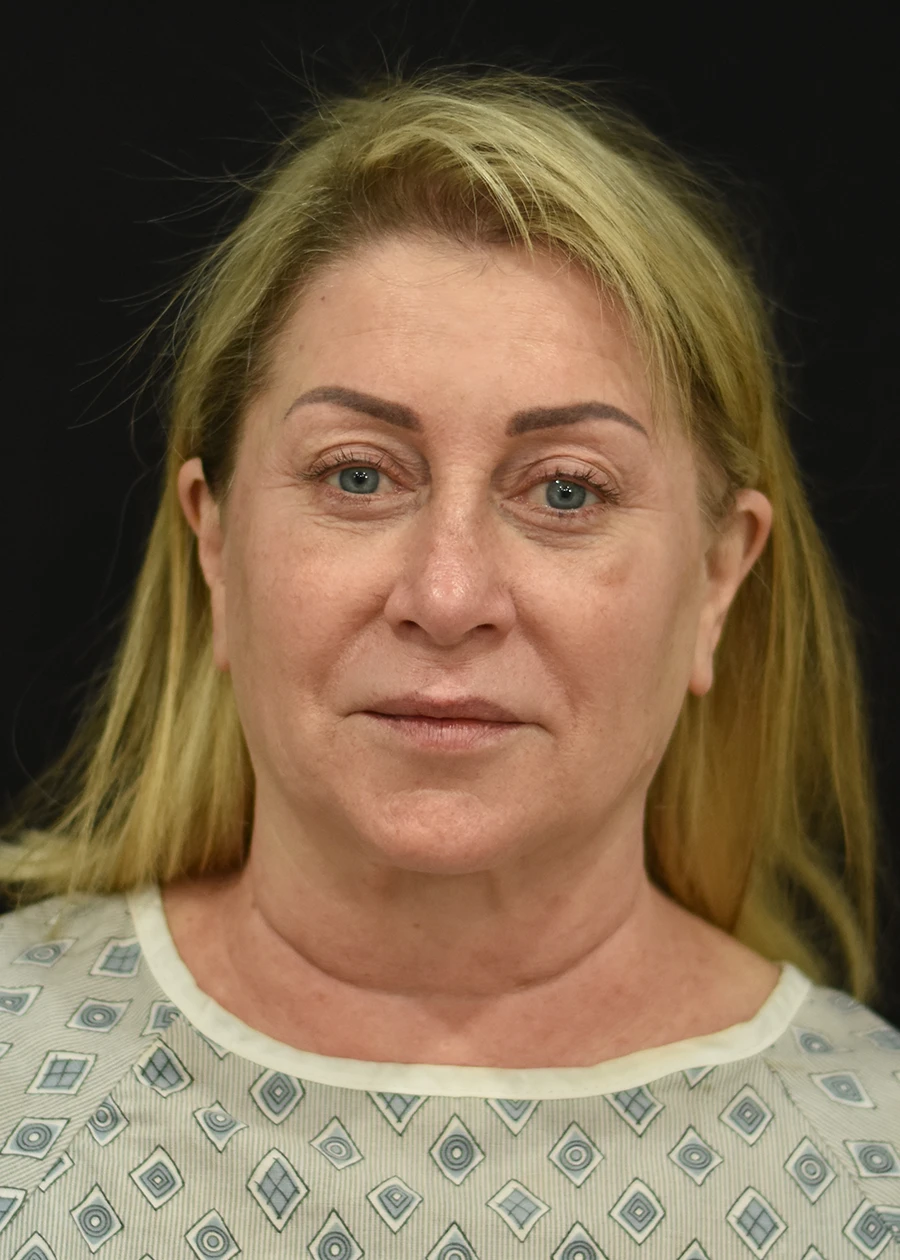 Extended Deep Plane Facelift Patient 8 Set 1 Before