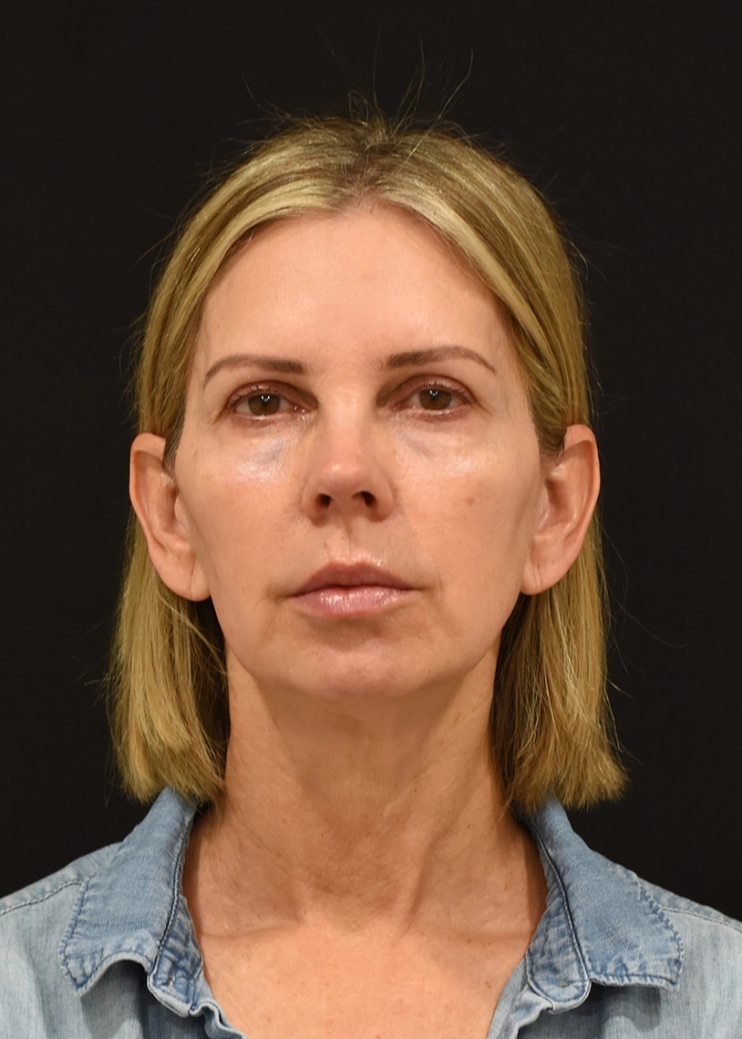 Extended Deep Plane Facelift Patient 1 Set 1 Before
