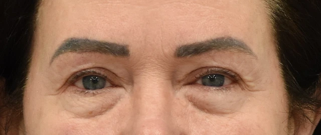 Brow Lift Patient 12 Set 1 Before