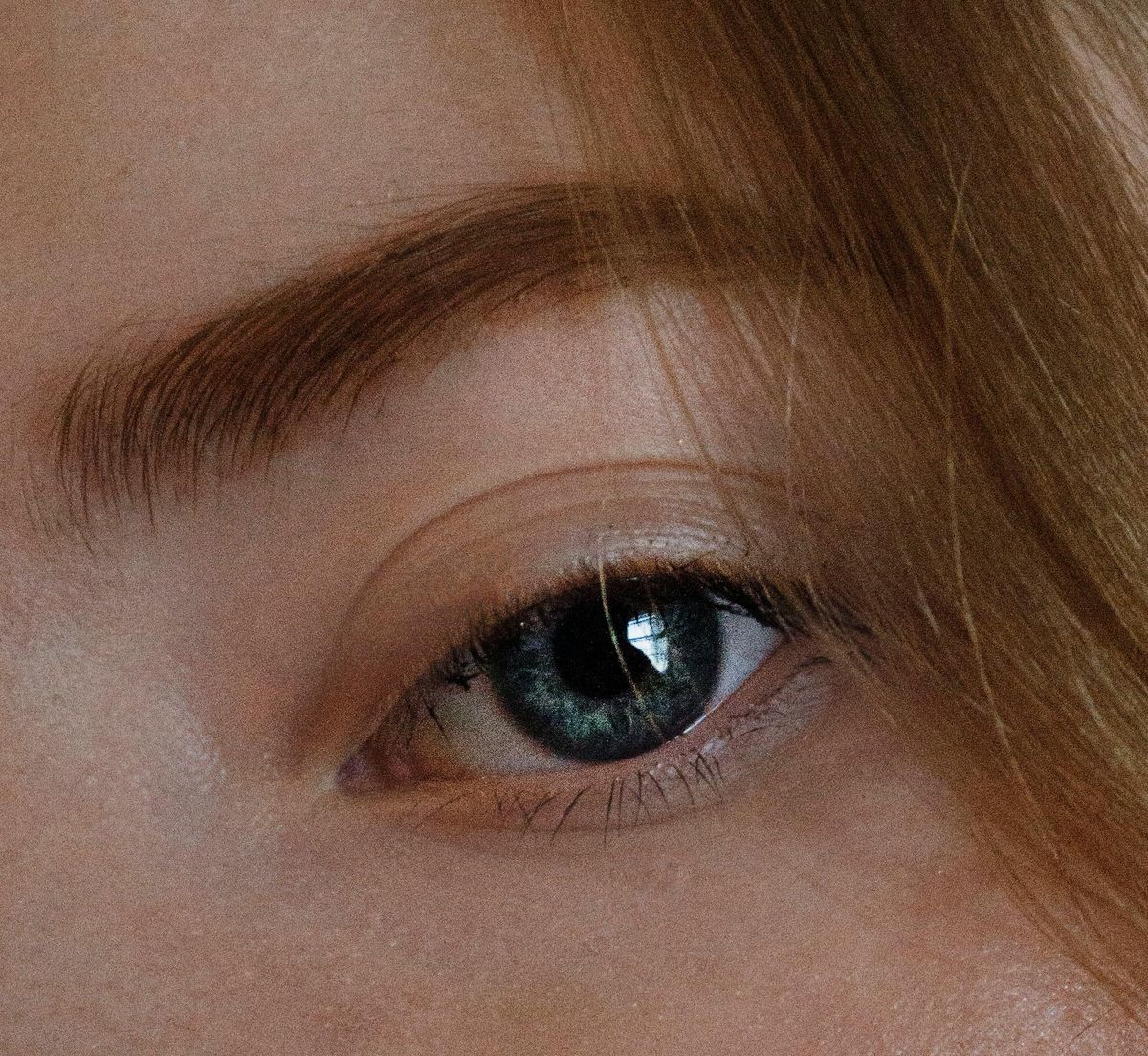 The Importance of Maintaining Lower Eyelid Support During Lower Eyelid Surgery