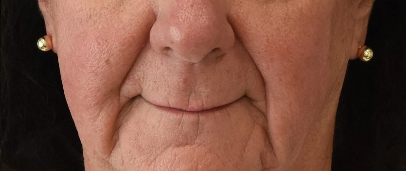 Lip Lift Patient 2 Set 1 Before