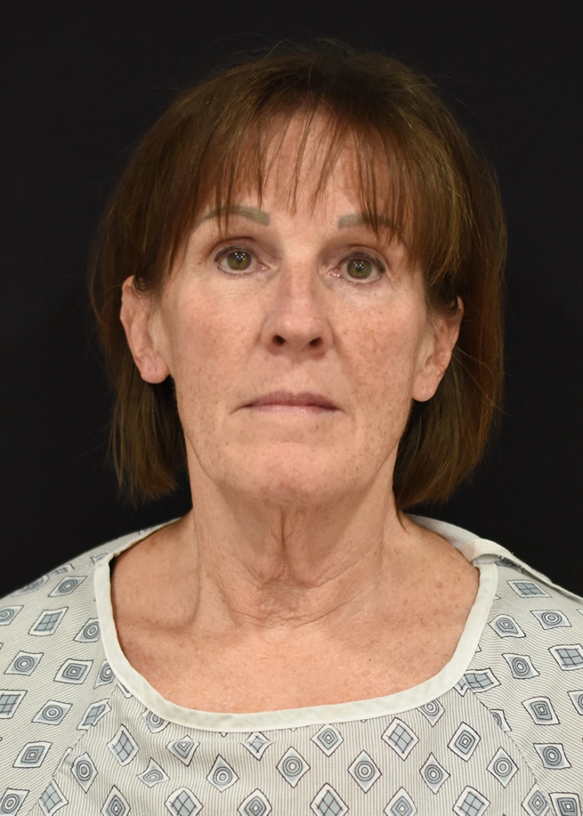 Extended Deep Plane Facelift Patient 2 Set 1 Before