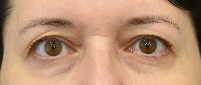 Eyelid Surgery Patient 6 Set 1 Before