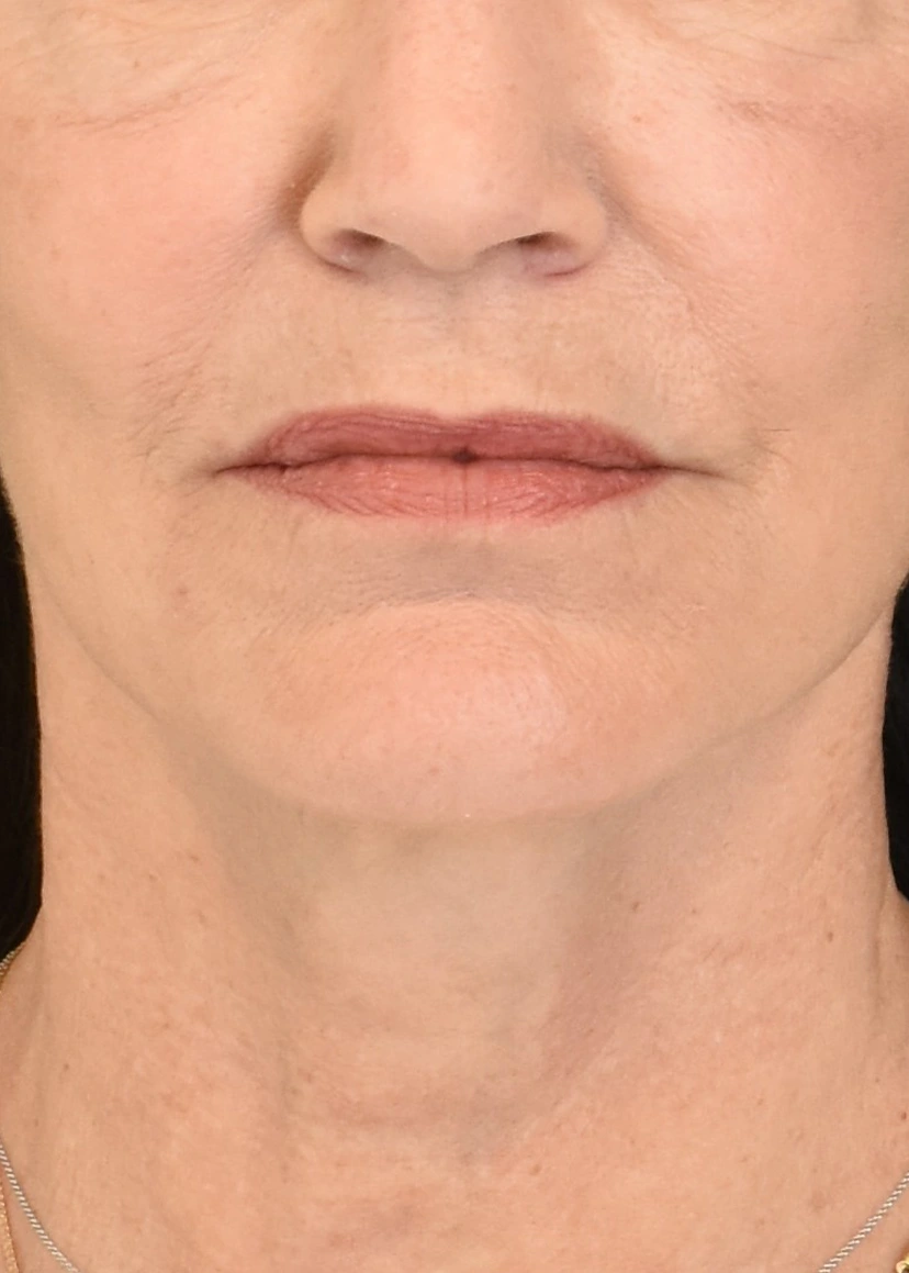 Deep Plane Facelift Patient 37 Set 1 After