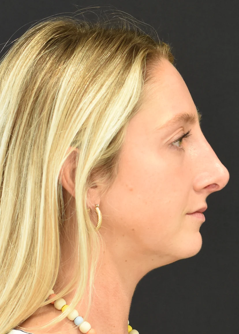 Rhinoplasty Patient 6 Set 3 After