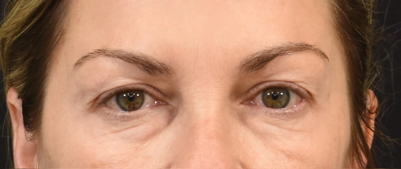 Eyelid Surgery Patient 2 Set 1 Before