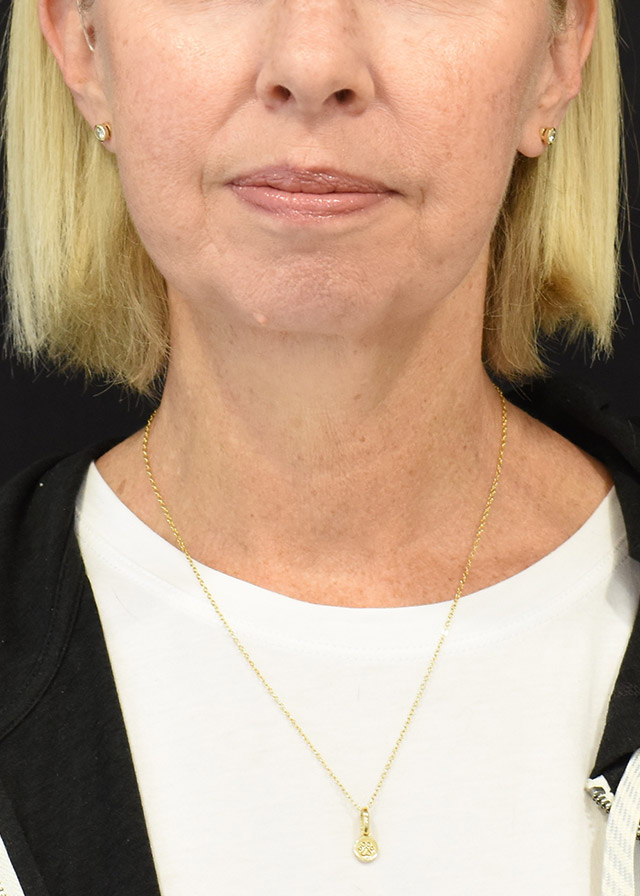 Neck Lift Patient 16 - Set 1 - After