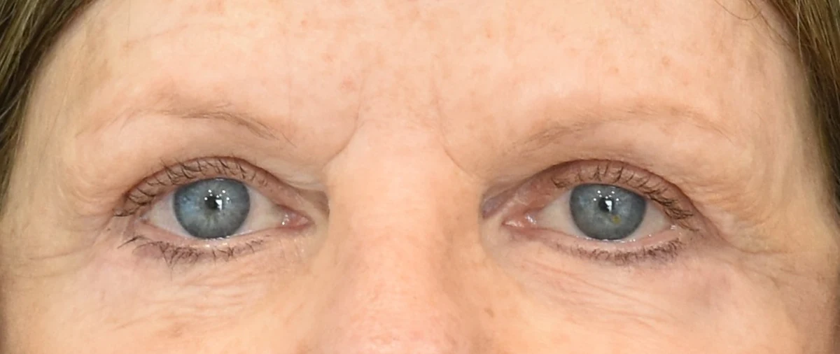 Eyelid Surgery Patient 18 - Set 1 - After